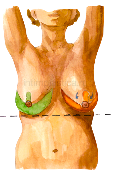 Подтяжка груди - мастопексия, редукция груди