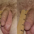 Удлинение полового члена. До и после операции.
