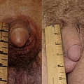 Удлинение полового члена. До и после операции.
